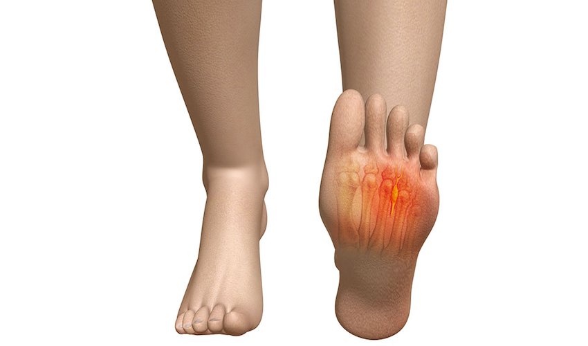 Νευρίνωμα Morton