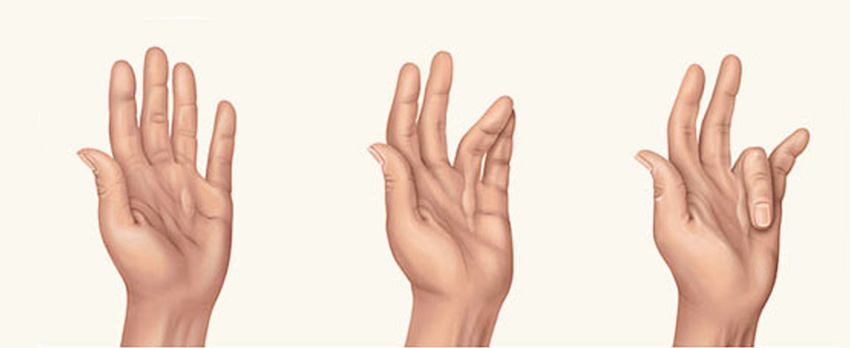 παραμόρφωση dupuytren