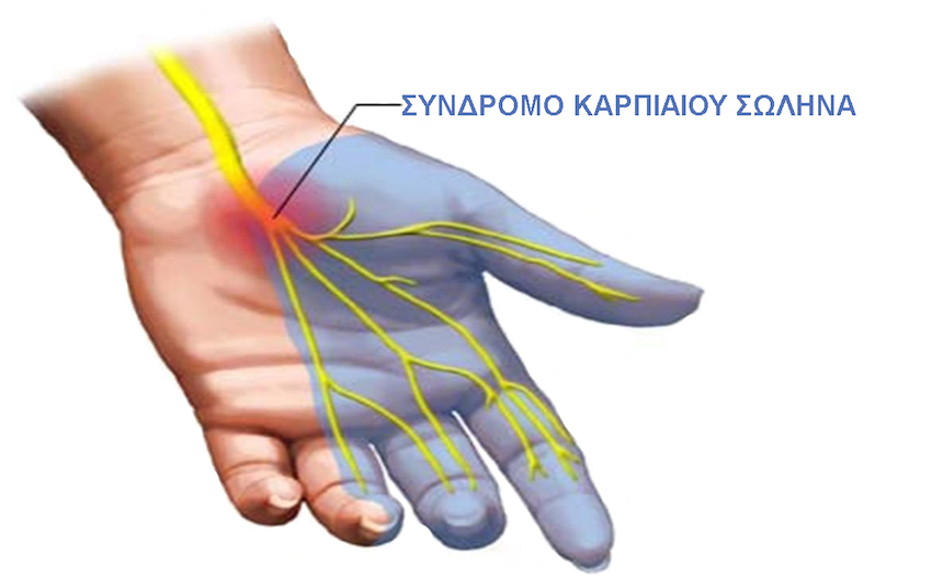 σύνδρομο καρπιαίου σωλήνα