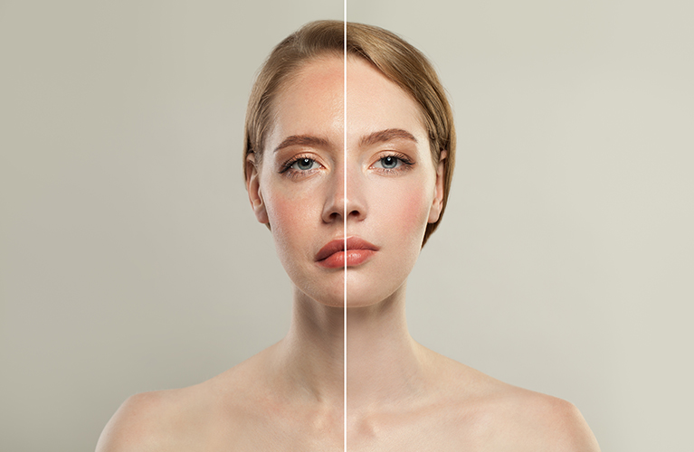 Πάρεση Προσωπικού Νεύρου